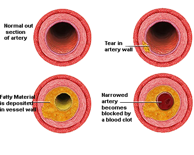 Atherosclerosis- SKA