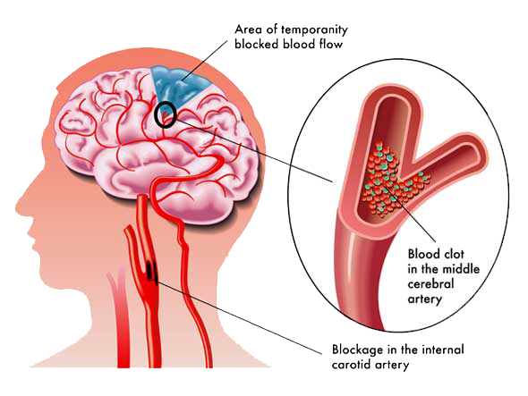 Carotid-SKA